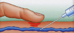 echosclerotherapy