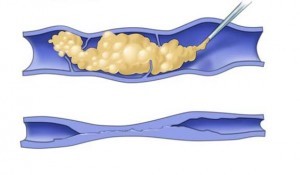 Fig 2 : traitement mini-invasif par laser endoveineux, scléromousse et embolisation par colle