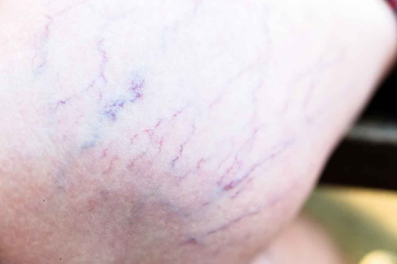 How are varicose veins diagnosed?