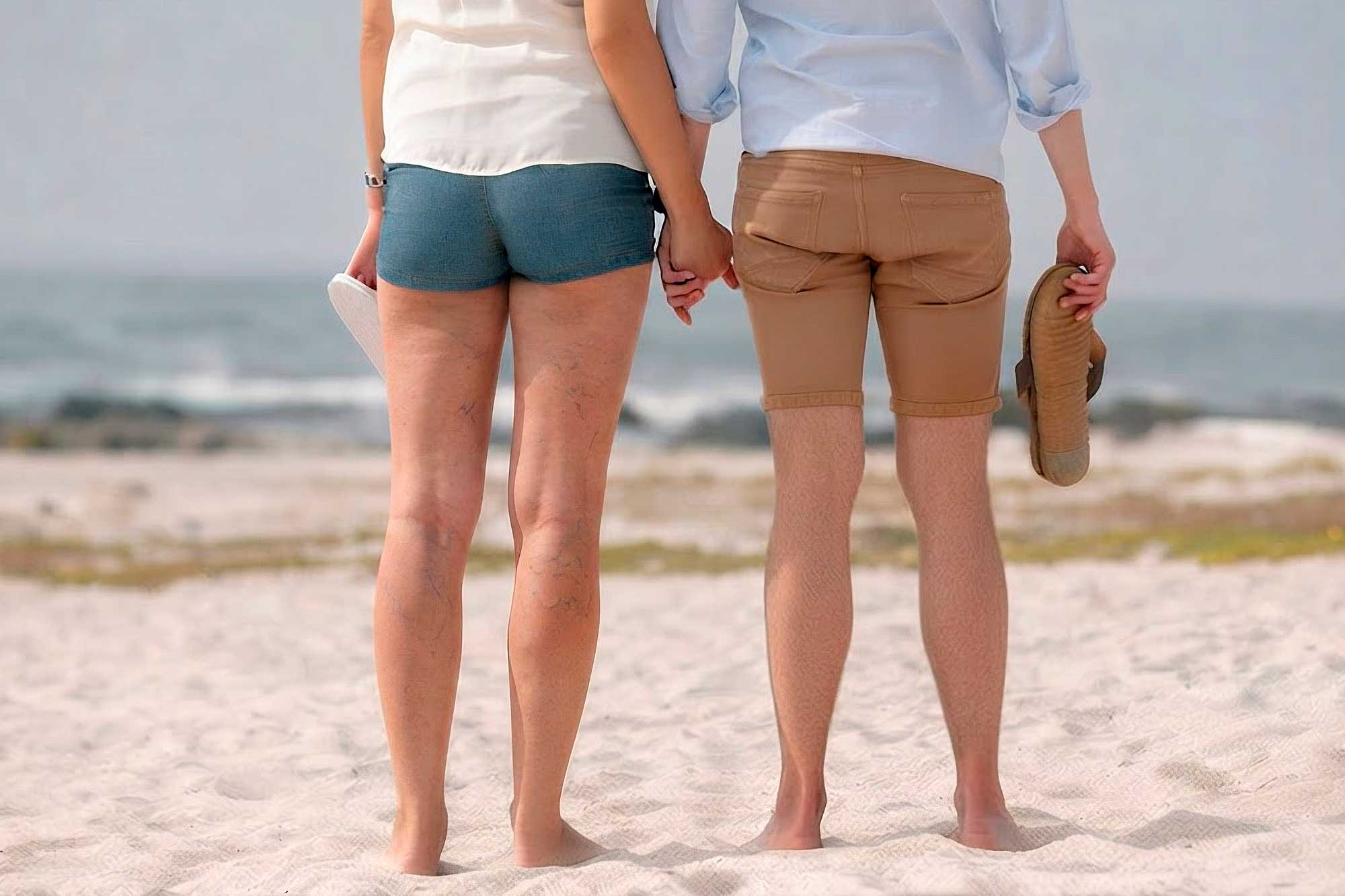 varices-femmes-hormones Comment fait-on le diagnostic de varices ?